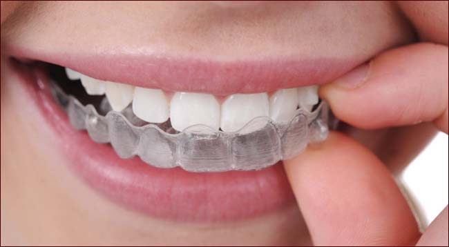 L'apparecchio invisibile Invisalign